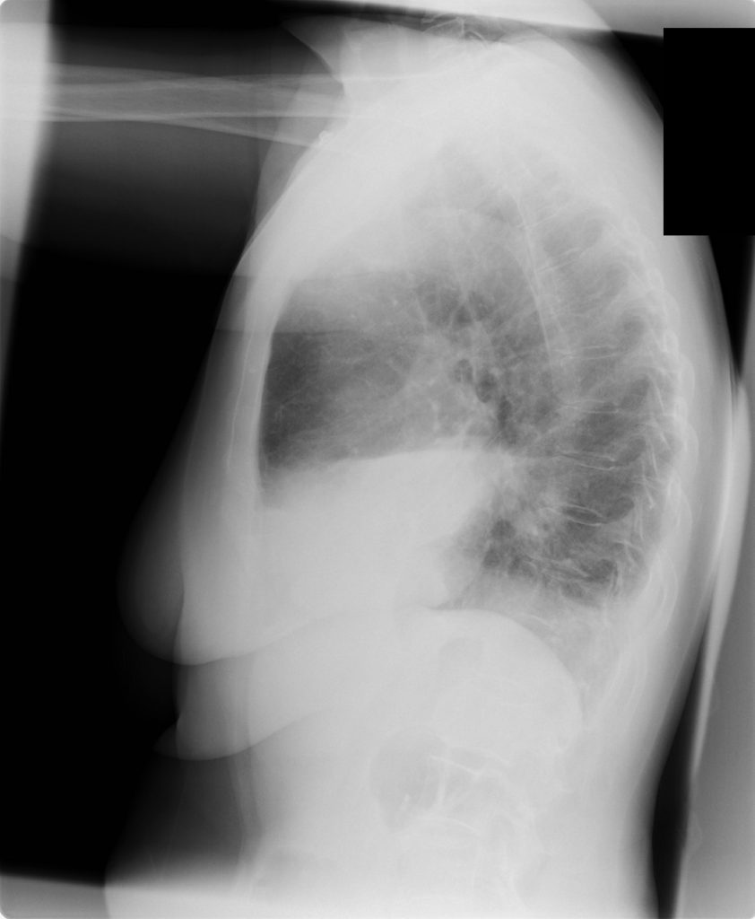 88. Lobar pneumonia – POCUS Cases